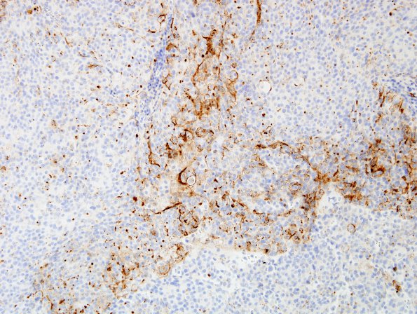 11B1 Meningioma, rhabdoid, Lymph node (Case 11) EMA 1.jpg