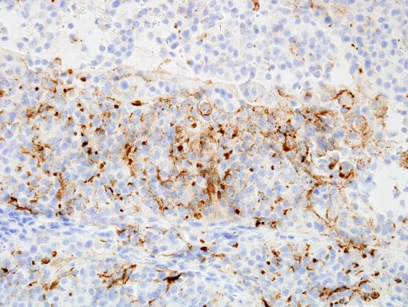 11B2 Meningioma, rhabdoid, Lymph node (Case 11) EMA 2.jpg