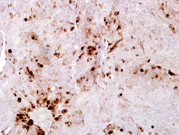 11C Meningioma, rhabdoid, Lymph node (Case 11) CK Oscar.jpg