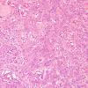 12A1 Meningioma, rhabdoid WHO ungraded (Case 12) H&E 5.jpg