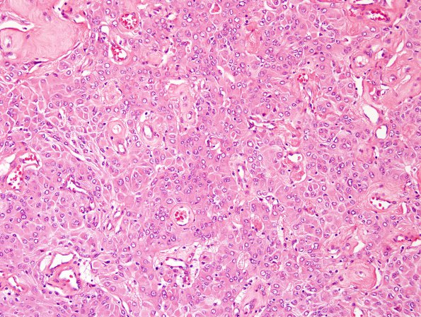 12A1 Meningioma, rhabdoid WHO ungraded (Case 12) H&E 5.jpg