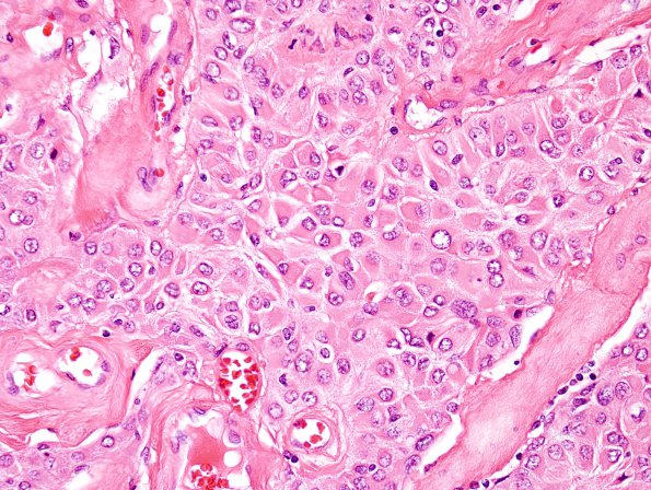 12A2 Meningioma, rhabdoid WHO ungraded (Case 12) H&E 7.jpg