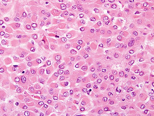 12A3 Meningioma, rhabdoid WHO ungraded (Case 12) H&E 8.jpg