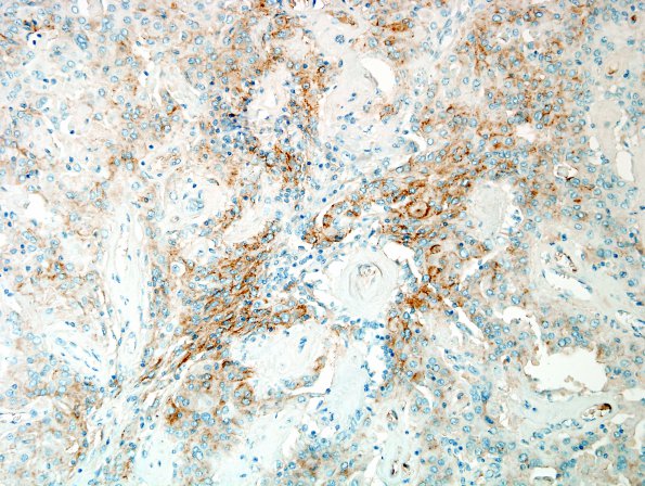 12B1 Meningioma, rhabdoid WHO ungraded (Case 12) EMA max area 1.jpg