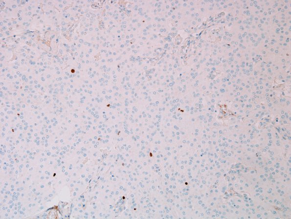 12D Meningioma, rhabdoid WHO ungraded (Case 12) Ki67 1.jpg