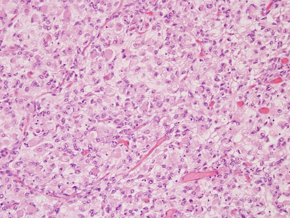 13A1 Meningioma, rhabdoid (Case 13) H&E 1