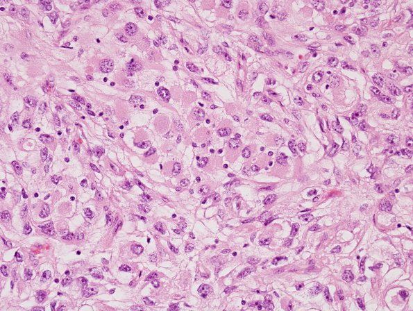 13A3 Meningioma, rhabdoid (Case 13) H&E 2