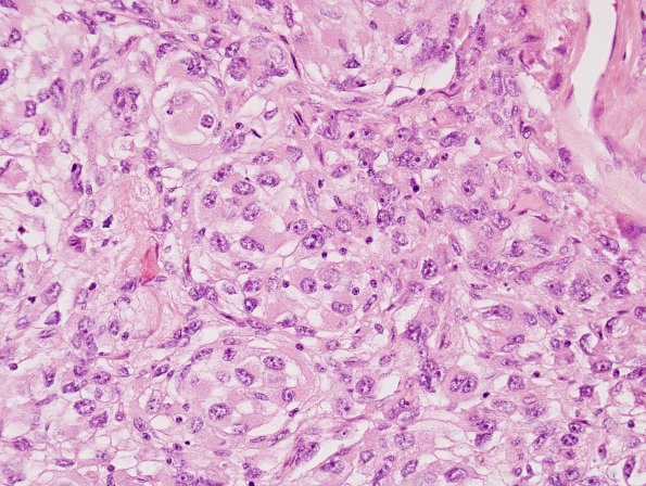 13A4 Meningioma, rhabdoid (Case 13) H&E 3