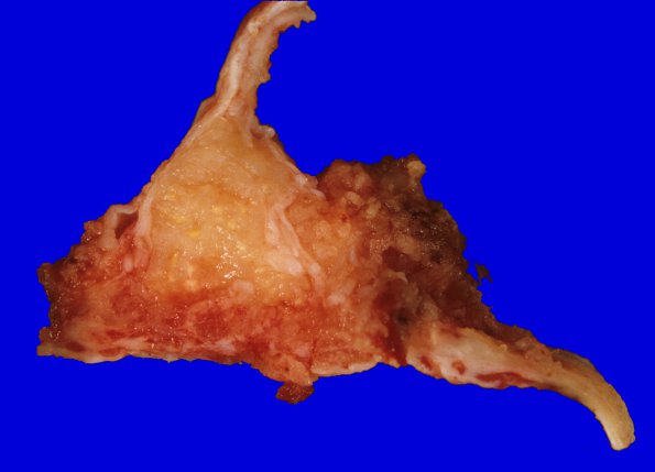 14A Meningioma, atypical (Case 14) focal rhabdoid sinus 1