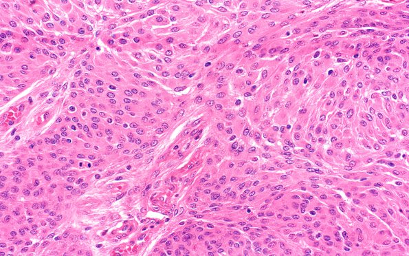 14B2 Meningioma, atypical (Case 14) 40X