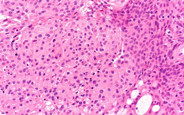 14B3 Meningioma, atypical (Case 14) 40X 3