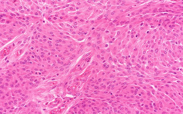 14B4 Meningioma, atypical (Case 14) 40X