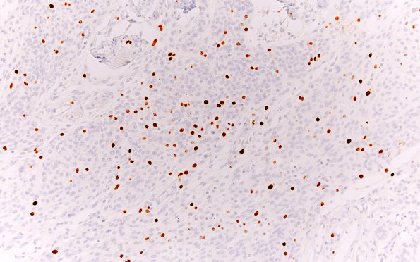 14D Meningioma, atypical (Case 14) Ki67 20X 2