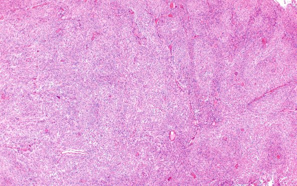 16A1 Rhabdoid Meningioma (Case 16) H&E X4