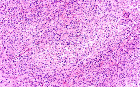 16A2 Rhabdoid Meningioma (Case 16) H&E 20X 2