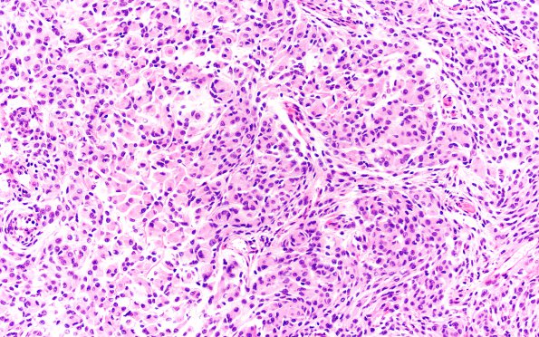 16A3 Rhabdoid Meningioma (Case 16) H&E 20X