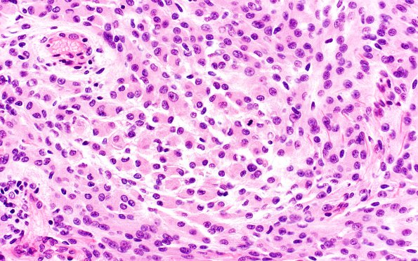 16A4 Rhabdoid Meningioma (Case 16) H&E 40X 2