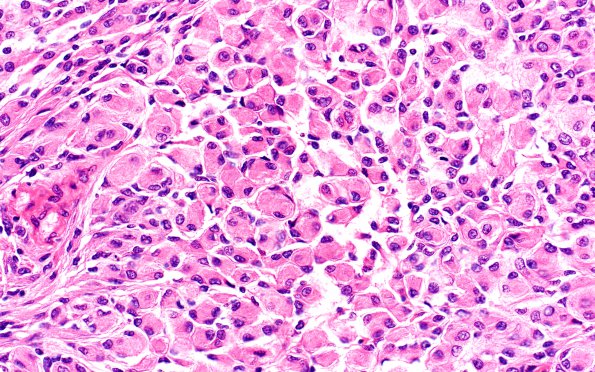 16A5 Rhabdoid Meningioma (Case 16) H&E 40X