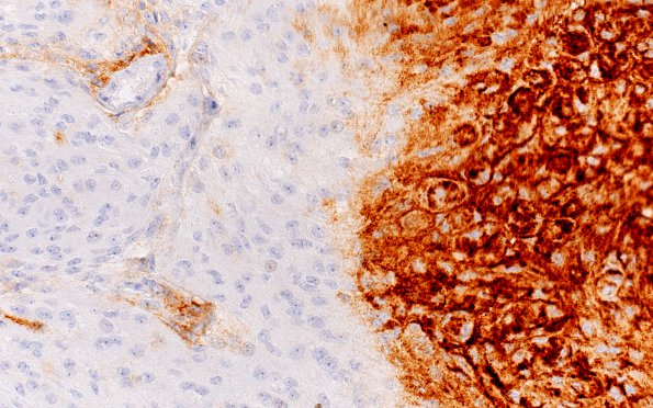 16B2 Rhabdoid Meningioma (Case 16) EMA 40X