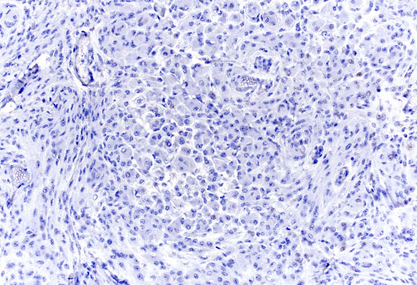 16C Rhabdoid Meningioma (Case 16) PR 20X