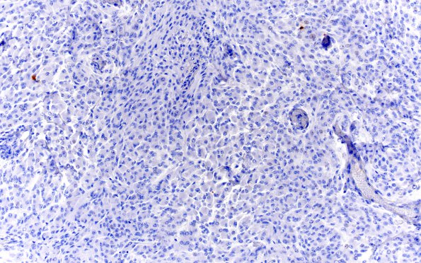 16E Rhabdoid Meningioma (Case 16) CK 20X