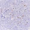 16F Rhabdoid Meningioma (Case 16) Ki67 20X