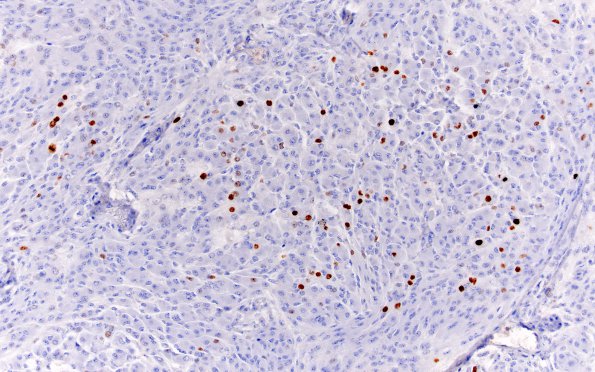 16F Rhabdoid Meningioma (Case 16) Ki67 20X