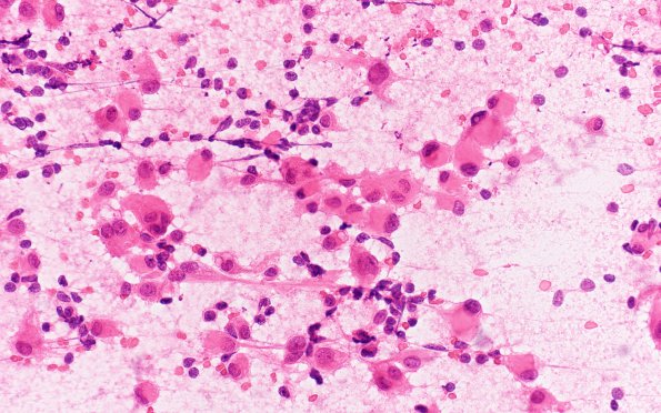 17A1 Rhabdoid Meningioma (Case 17) H&E Smear 40X