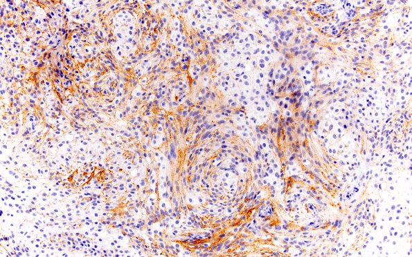 17B Rhabdoid Meningioma (Case 17) EMA 20X