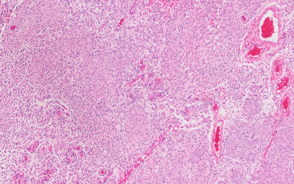 18A1 Meningioma, rhabdoid (Case 18) H&E 10X 2