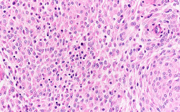 18A2 Meningioma, rhabdoid (Case 18) H&E 40X 1