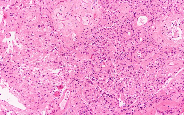 19 Rhabdoid meningioma (Case 19) H&E 20X