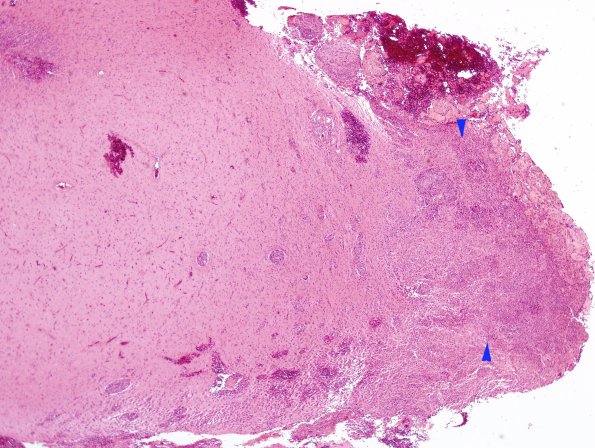 1A1 Meningioma, rhabdoid (Case 1) H&E 2X AP copy.jpg