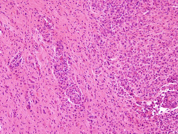 1A2 Meningioma, rhabdoid (Case 1) H&E 1.jpg