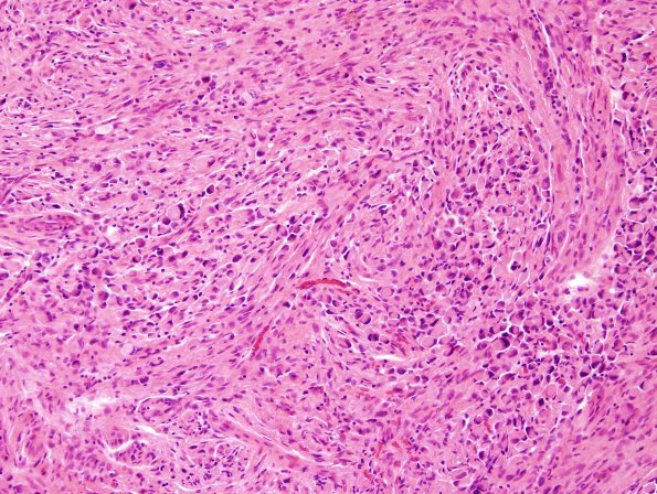 1A3 Meningioma, rhabdoid (Case 1) H&E 6.jpg