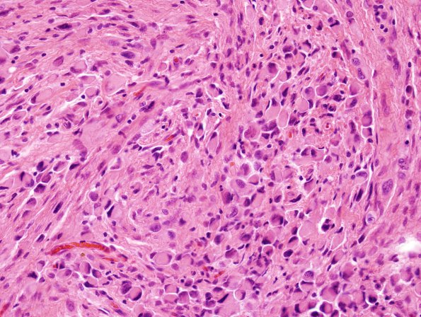 1A4 Meningioma, rhabdoid (Case 1) H&E 7.jpg