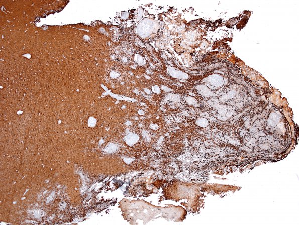 1C1 Meningioma, rhabdoid (Case 1) GFAP 4X.jpg