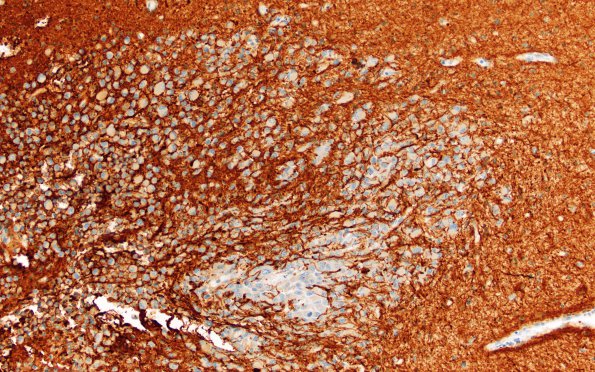 1C3 Meningioma, rhabdoid (Case 1) GFAP 20X 2 areaA