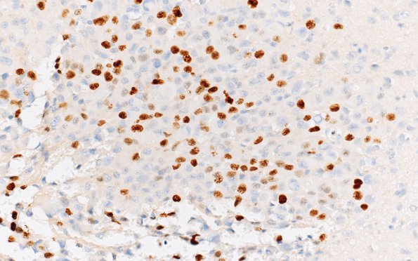 1D1 Meningioma, rhabdoid (Case 1) Ki67 40X areaA