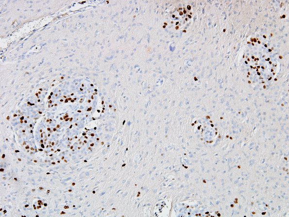 1D2 Meningioma, rhabdoid (Case 1) Ki67 2.jpg