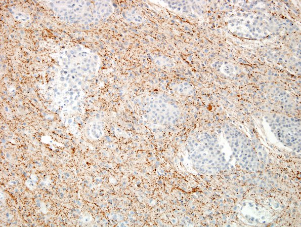 1F Meningioma, rhabdoid (Case 1) SYN 1.jpg