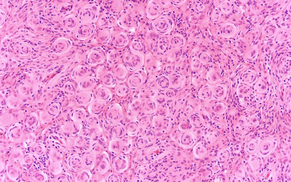 20A1 Rhabdoid meningioma (Case 20) H&E 20X 1