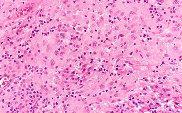 20A2 Rhabdoid meningioma (Case 20) H&E 40X 2