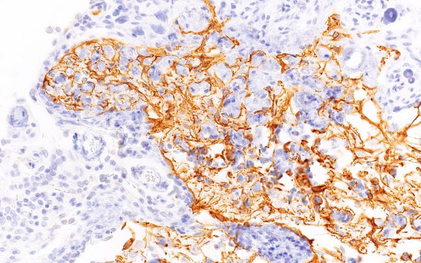 20B Rhabdoid meningioma (Case 20) GFAP 40X 1