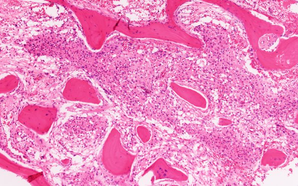 23A Meningioma, rhabdoid (Case 23) H&E 10X 1