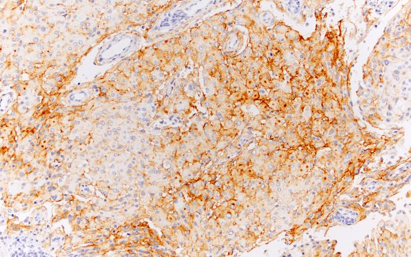 23B1 Meningioma, rhabdoid (Case 23) EMA 20X 2