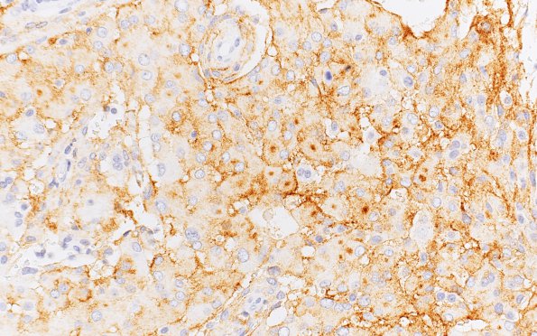 23B2 Meningioma, rhabdoid (Case 23) EMA 40X 2