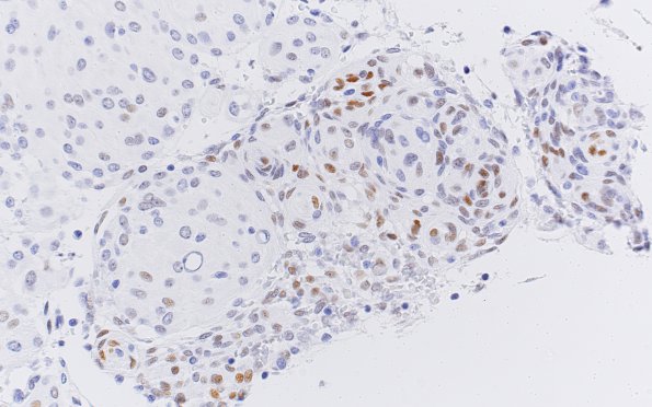 23C Meningioma, rhabdoid (Case 23) PR 40X 1