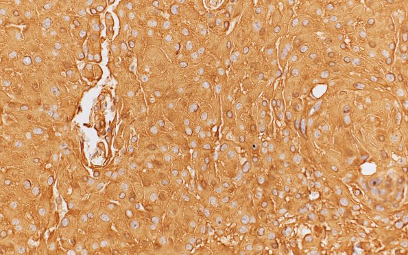 23D Meningioma, rhabdoid (Case 23) VIM 40X 1 (2)