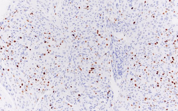 23E Meningioma, rhabdoid (Case 23) Ki67 20X 1